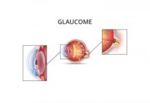 Glaucome : le voleur silencieux de la vue